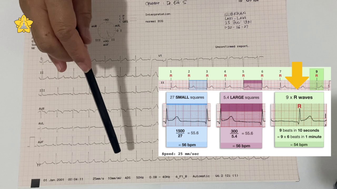 Analisa Electrocardiograph - dr. Sri Murdiati, Sp. JP-FIHA