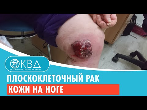 🦵 Плоскоклеточный рак кожи на ноге. Клинический случай №942