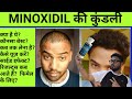 Most complete video on Minoxidil - कब तक यूज़ करना चाहिए - Hair Transplant के बाद - Hair Fall बढ़ा?