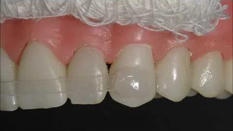 Quando deve ser utilizado a contenção rígida e a Semi-rígida?
