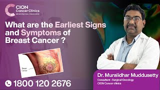 Play video: What are the Earliest Signs and Symptoms of Breast Cancer