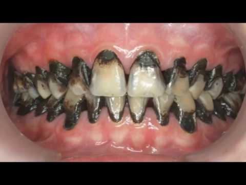 remedios naturales para la artritis 🔴✅NO IMPORTA CUANTAS CARIES TENGAS ELIMINALA DESDE CASA FÁCILMENTE…ENJUAGUE BUCAL NATURAL