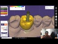 Scan Body and Screw Retain Implant Crown Design