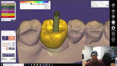 Scan Body and Screw Retain Implant Crown Design