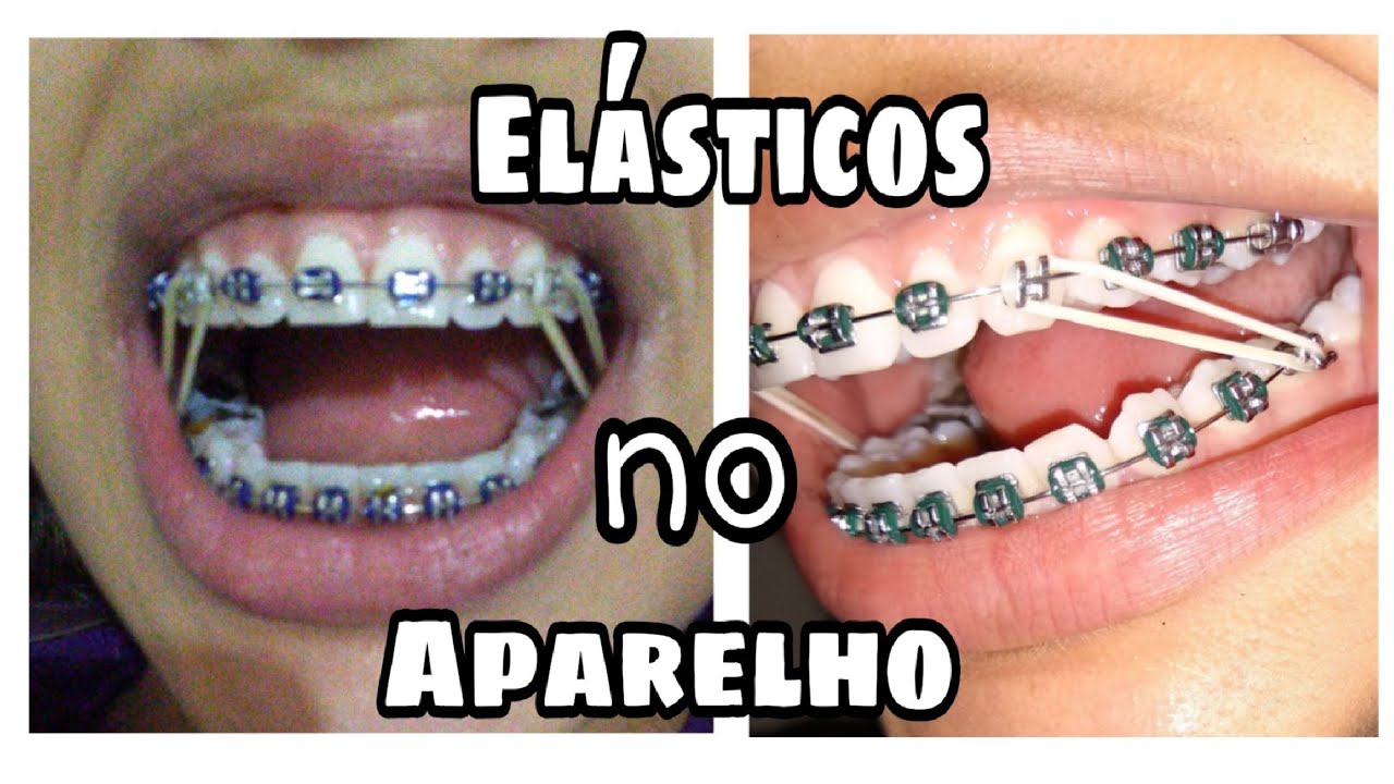 Coloquei os elásticos no aparelho, Após 1 ano de uso... - YouTube