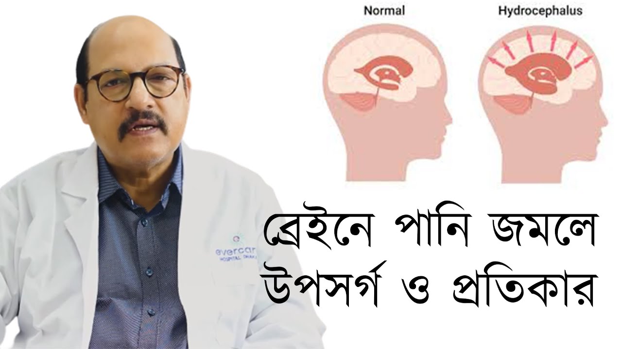 Hydrocephalus Symptoms and remedies for water accumulation in the brain Prof Dr Md Zillur Rahman