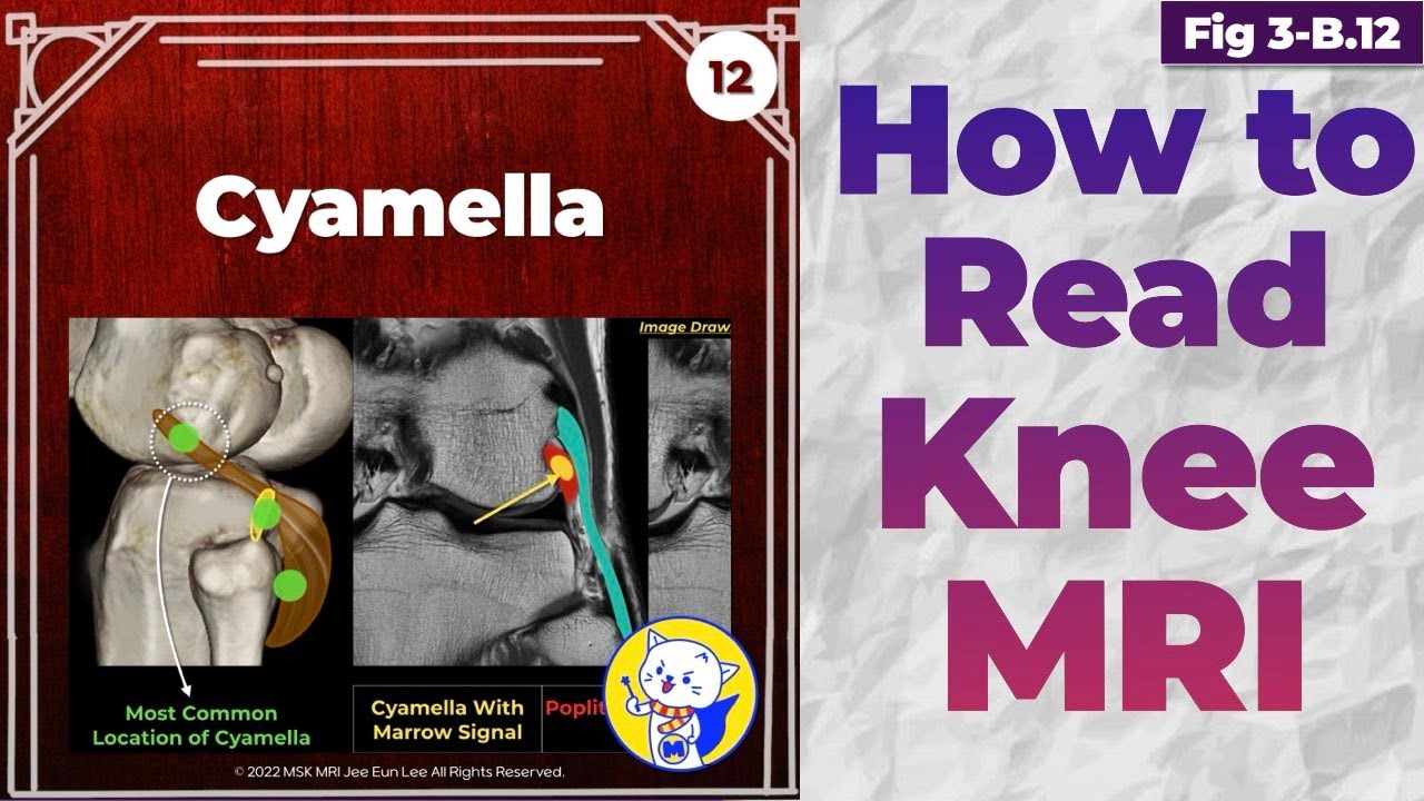 (Fig 3-B.12) Cyamella vs Fabella - YouTube