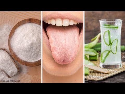 Video: Witte Tandplak Op De Tong - Oorzaken En Behandeling Van Witte Tandplak Op De Tong, Waarom Wordt Het Gevormd?