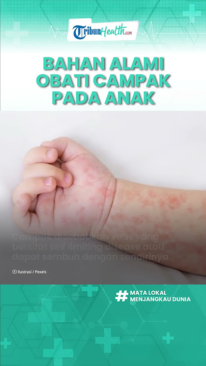 Bahan Alami yang Dapat Obati Campak pada Anak, Bawang Merah hingga Daun Jarak