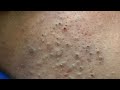 [ASMR] Morning &amp; Nighttime Facial Routines for Acne-Prone Skin &amp; Blackheads
