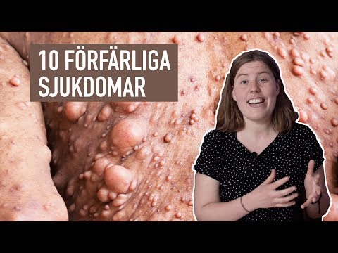 10 Förfärliga Sjukdomar Du Inte Vill Råka Ut För