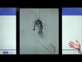 Thyroid Artery Embolization: New treatments for enlarged thyroid and thyroid nodules | UCLA Health
