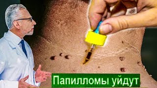 Врачи нашли Способ УБРАТЬ Все ПАПИЛЛОМЫ Дома за Несколько Дней! Потребуется только... Врачи нашли Способ УБРАТЬ Все ПАПИЛЛОМЫ Дома за Несколько Дней! Потребуется только...