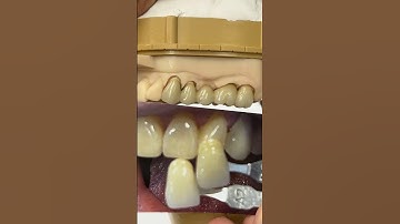 Metal Ceramic Bridge @EnvisiontecMain #envisiontec #lsk121shorts #teeth #dental