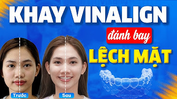Khay Vinalign | Tái Cấu Trúc Nụ Cười Hô, Chen Chúc, Mặt Lệch | Nam Bui Vinalign