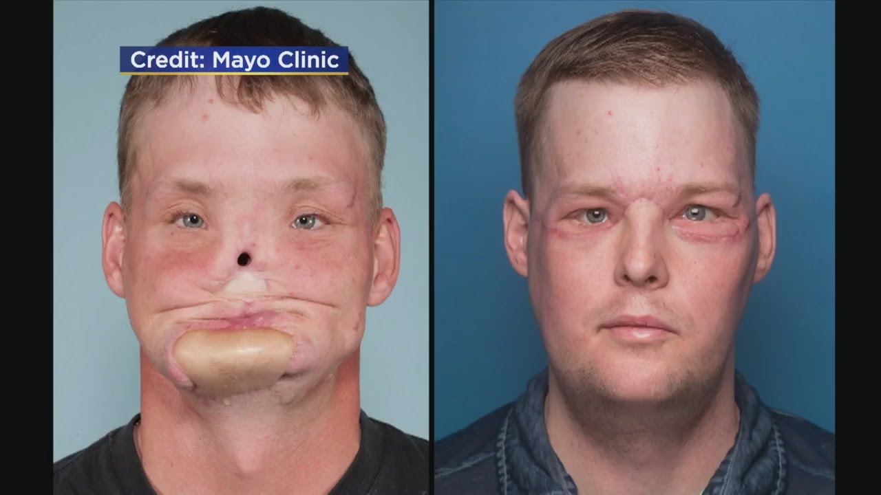 Watch World’s first full face transplant video Watch World’s first full face transplant video