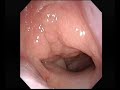 Adenoidectomy with coblation