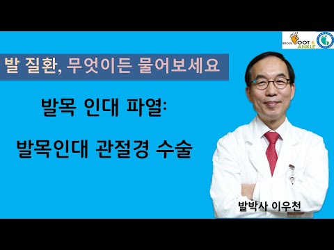 발목인대 관절경 수술이란? [발 질환, 무엇이든 물어보세요]