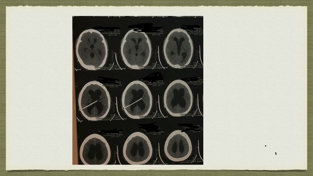 ازالة صمام المخ بعد ٣٠ سنة : جراحة المنظار الجديدة 