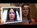 LIQUID FACELIFT - ULTIMATE Dermal Filler MAKEOVER!