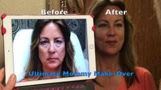 LIQUID FACELIFT - ULTIMATE Dermal Filler MAKEOVER!