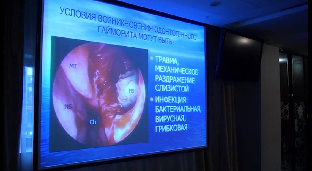 Клинико-лучевая диагностика и лечение хронического риносинусита ...