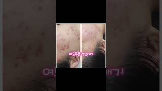 청주분평동여드름관리 여드름흉터 여드름압출 사춘기여드름 청주분평동피부관리 스무살에머물다청주분평점 에르벨에스테틱청주분평점