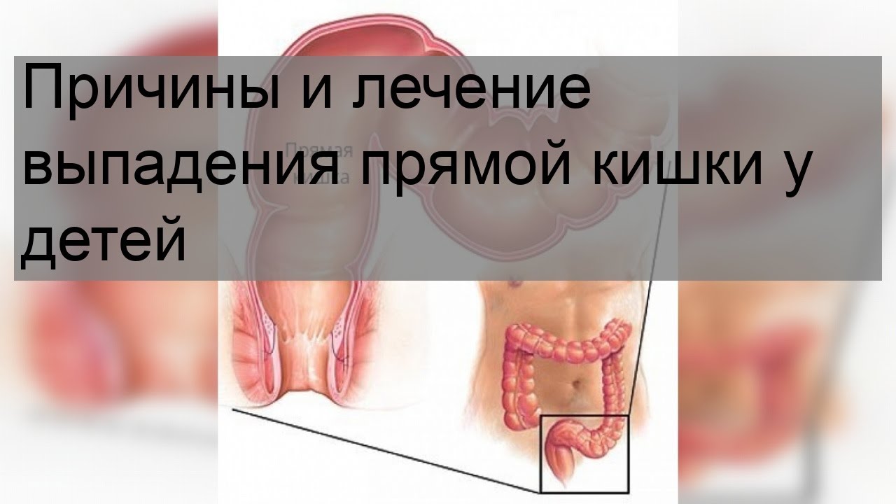 Причины и лечение выпадения прямой кишки у детей - YouTube