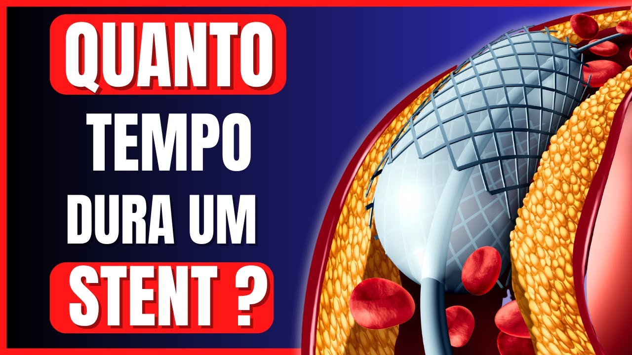QUAL O PRAZO DE VALIDADE DE UM STENT? QUAL A DURAÇÃO DE UM STENT no coração?