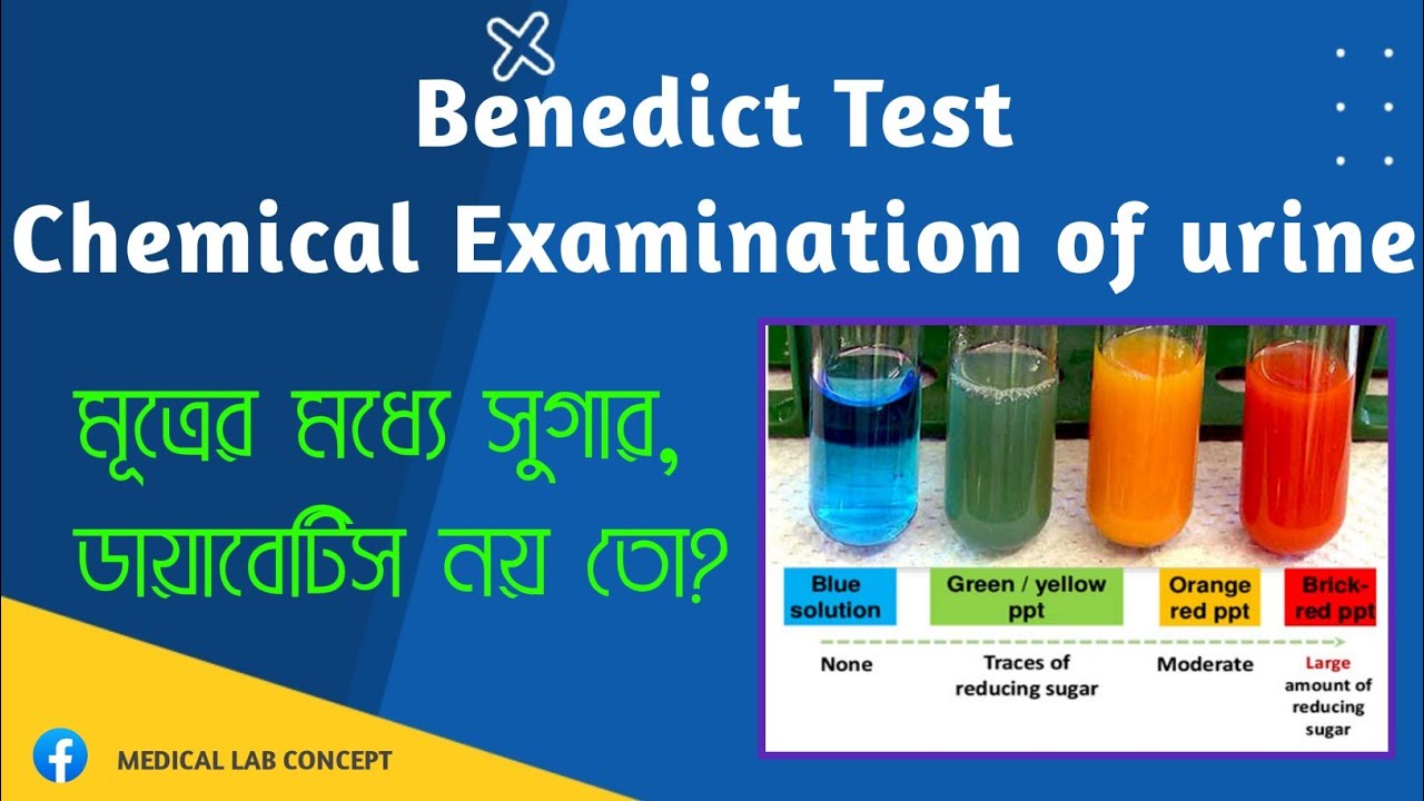 Urinary Sugar Test Benedict TestMedical Lab Concept YouTube