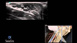 How To Ultrasound Guided Axillary Nerve Block 3D Video