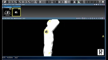 Spinning MIP Demo - Saince Merge PACS