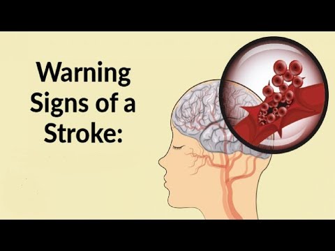 How To Prevent A Stroke Before It’S Too Late !Early Signs Of Stroke.