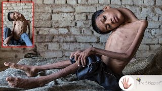 No-Muscles Boy survives riskiest surgery to straighten his neck! After surgery pics! ~ Body Bizarre!