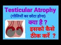 Varicocele and testicular atrophy.