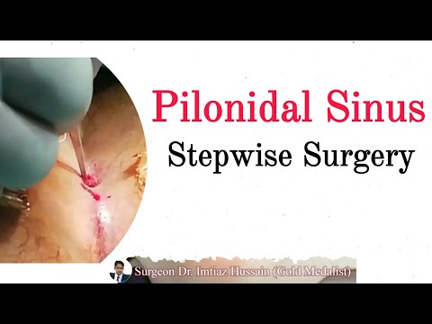 Pilonidal Sinus | Stepwise Surgery Explained | Surgeon Dr Imtiaz Hussain