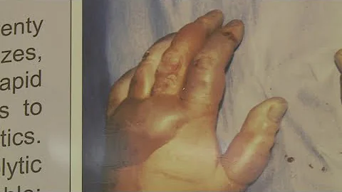 How do you treat frostbite? FDA approves first drug to treat severe frostbite