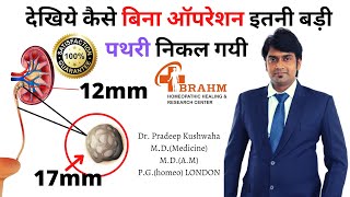 17mm kidney stone | 12mm kidney stone removed without surgery | 17mm की पथरी कैसे निकाल दी ये दवा screenshot 2