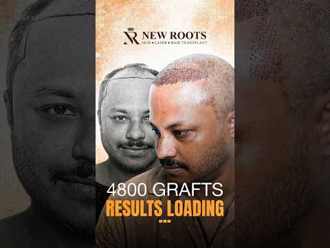 Hair Transplant in Kolkata (4800 Grafts) | Cost and Procedure #hairtransplant #kolkata #shorts