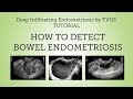 Deep Infiltrating Bowel Endometriosis Detection by TVUS Tutorial