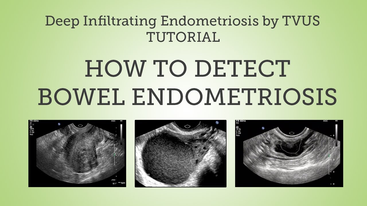 Deep Infiltrating Bowel Endometriosis Detection By Tvus Tutorial