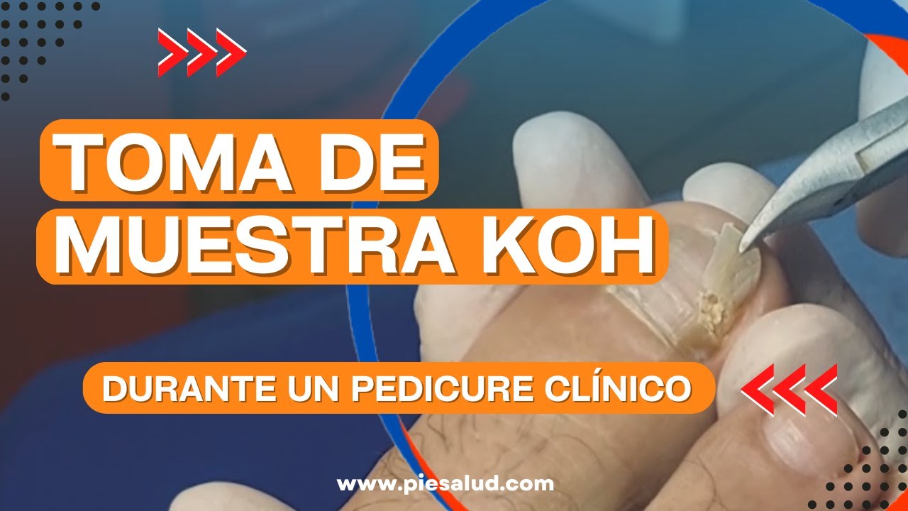 📌Toma de muestra KOH durante un PEDICURE CLÍNICO🔥 - YouTube