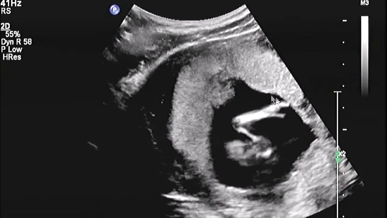 2D Echo 13 Weken Geslachtsbepaling Jongen, met ingesproken uitleg YouTube 2D Echo 13 Weken Geslachtsbepaling Jongen, met ingesproken uitleg YouTube