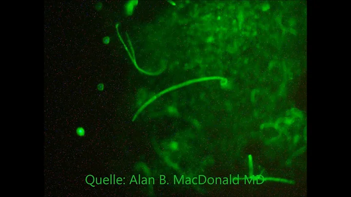 Wurm im Gehirn bei MS / Video von Dr. Alan B. MacDonald
