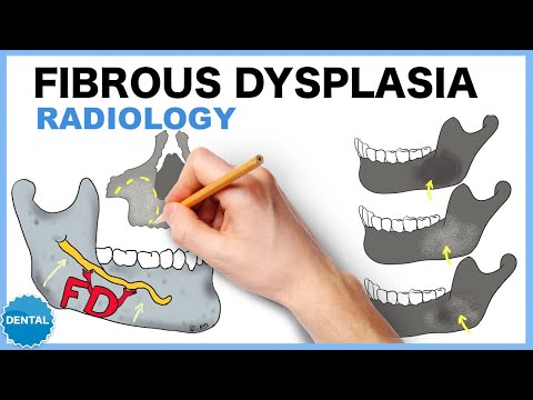 Video: Kdo léčí fibrózní dysplazii?
