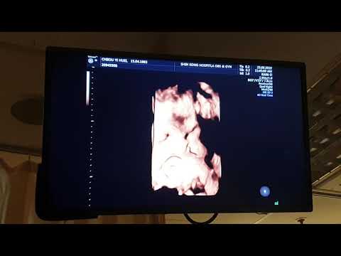 1080923，38周5天，出血（咖啡色血3天）被醫生留院催生之超音波