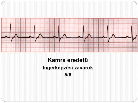 Videó: Kamrai Korai ütések - Tünetek és Kezelés