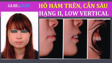 Ca 08 - GEAW: HÔ HÀM TRÊN, CẮN SÂU, HẠNG II, LOW VERTICAL. Maxillary protrusion, deep bite, class II