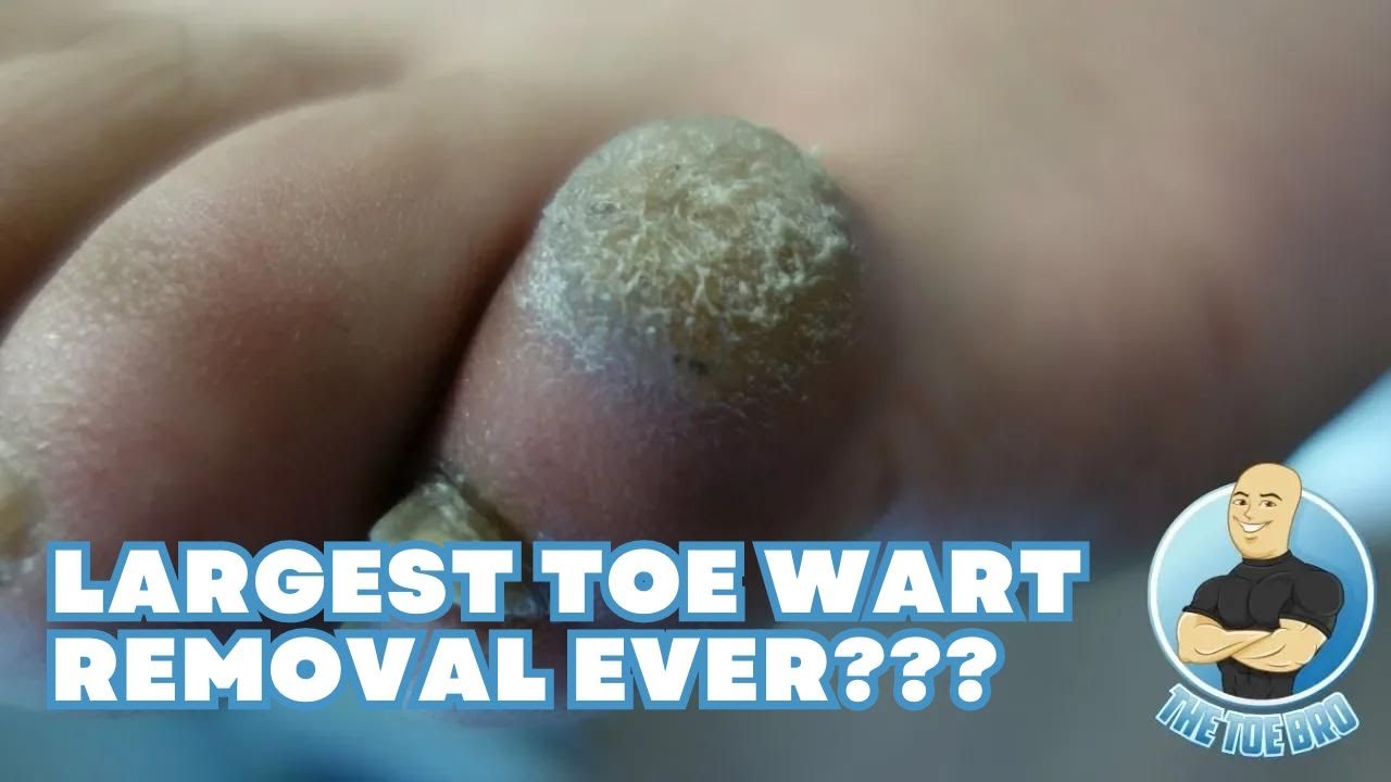 Largest Toe Wart Removal Ever???