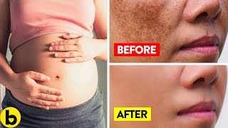 How You Can Deal With Pregnancy And Melasma